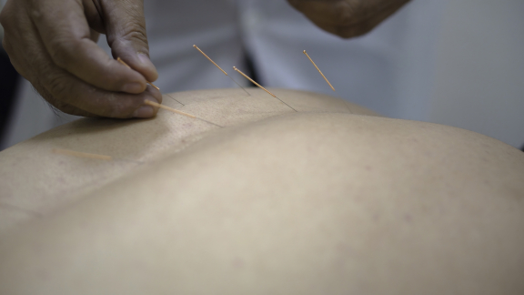 Acupunctuur